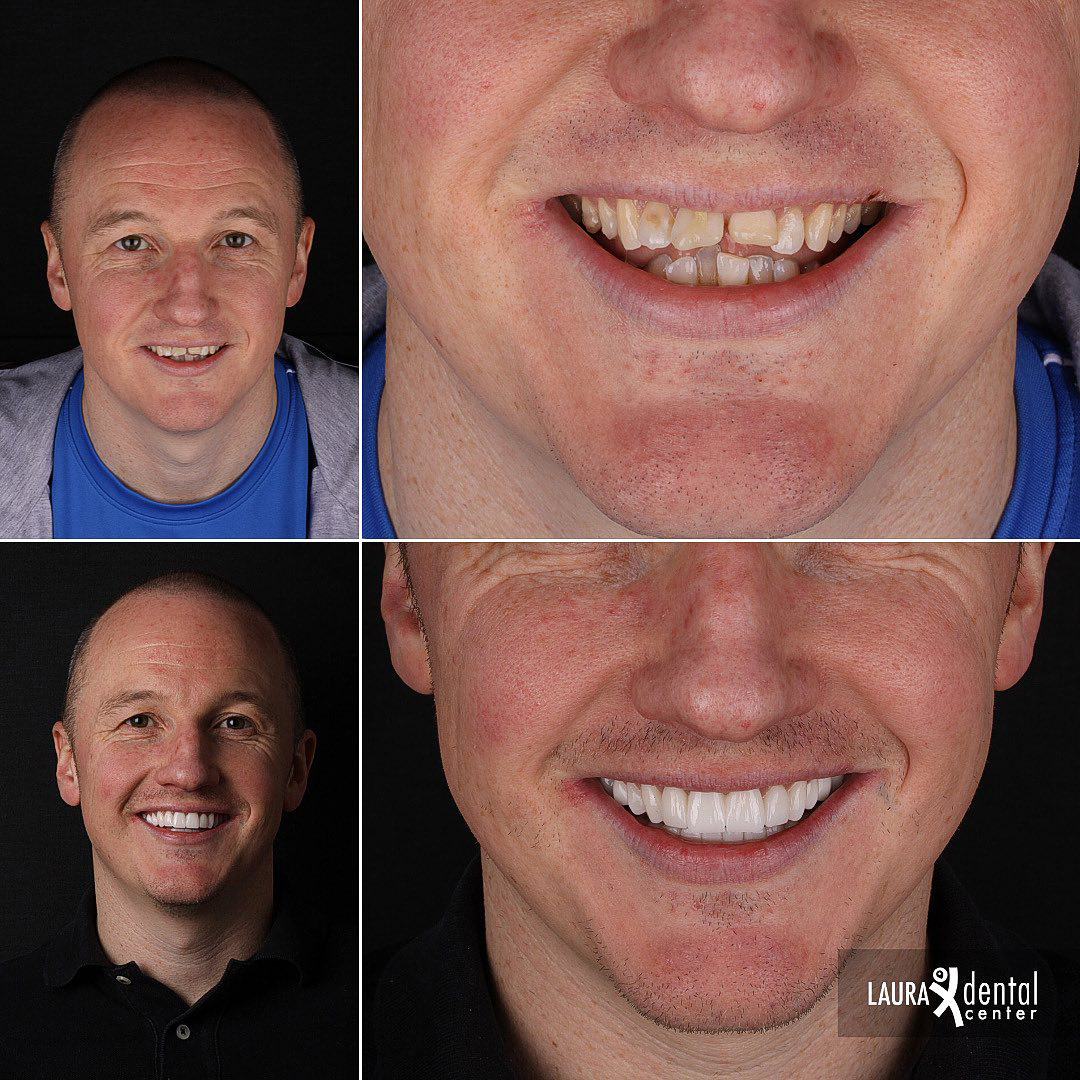 before and after dentist photo